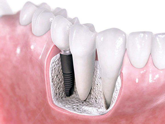 dental-implants