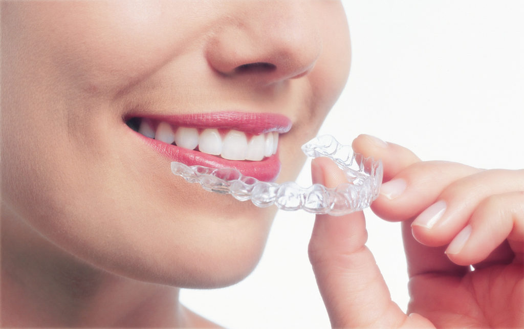 Braces